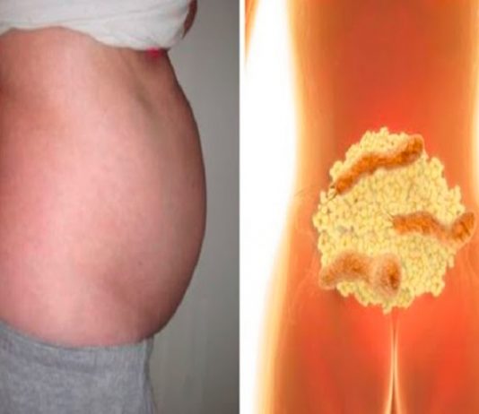 Patiesie iemesli par vēdera uztūkumu! Kā no tā atbrīvoties?