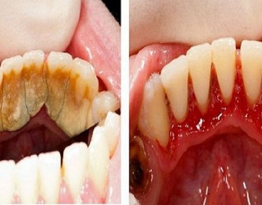 Tev vairs nav jāiet pie zobārsta! Uzzini kā atbrīvoties no zobakmens un padarīt smaidu žilbinošāku