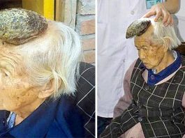 87 Gadus Vecā “Vienradžu Sieviete”, Kurai Uz Pieres Aug 13cm Rags. Lūk Kāda Ir Viņas Dzīve!