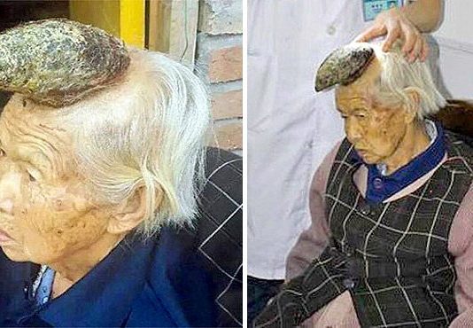 87 Gadus Vecā “Vienradžu Sieviete”, Kurai Uz Pieres Aug 13cm Rags. Lūk Kāda Ir Viņas Dzīve!