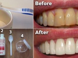 Kā Atbrīvoties No Aplikuma Tajā Pat Laikā Izbalināt Zobus Bez Dārgām Procedūrām, Kas Izmaksā Milzu Naudu!? Mums Ir Risinājums!