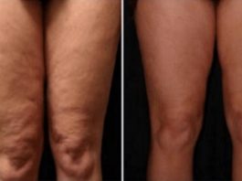 Vēlies Atbrīvoties No Celulīta Un Iegūt Ideāli Skaistas Kājas? Šī Sastāvdaļa Ikvienam Ir Mājās, Bet Neviens To Neizmanto!