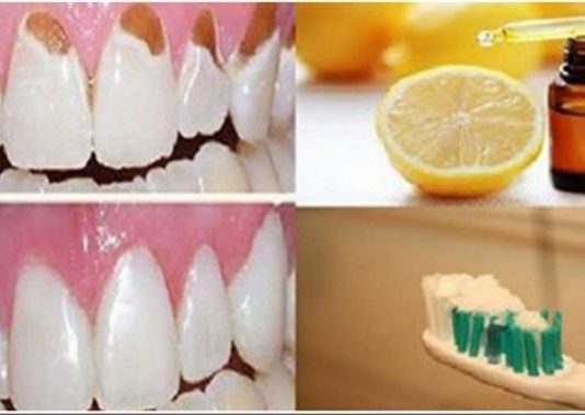 Novērs Savu Zobu Bojāšanos, Aizsargā Emāliju, Kā Arī Padari Zobus Daudz Baltākus Un Stiprākus Tikai Ar Vienu Īpašu Vielu!