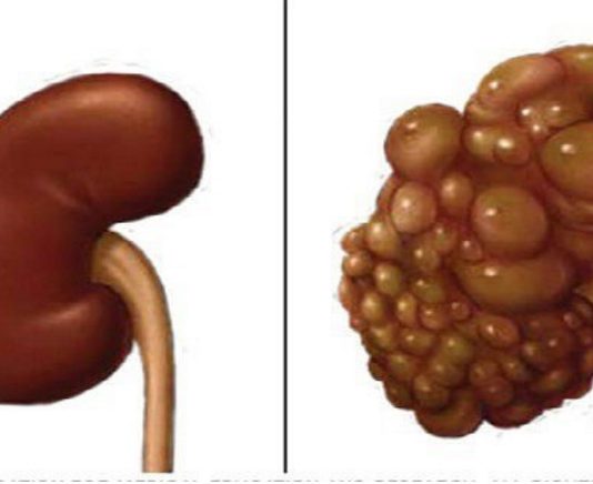 Izbeidz Bojāt Savas Nieres! Nekavējoties Pārtrauc Darīt Šīs Lietas Ja Negribi, Lai Tās Operē!