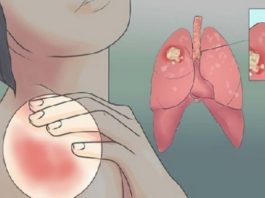 Ārsti Brīdina – Sievietēm Jābūt Piesardzīgām! 20 Plaušu Vēža Pazīmes, Kuras Sievietēm Nekad Nevajadzētu Ignorēt!