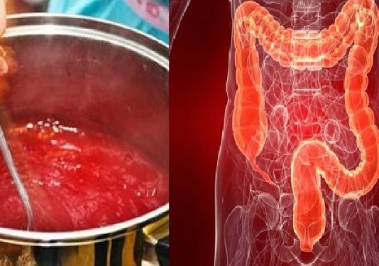 Dietologi Iesaka Vienu No Visu Labākajām Notievēšanas Formulām – To Pagatavot Un Lietot Ir Tik Vienkārši!