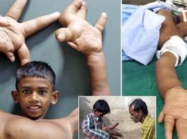 Puika Ar Pasaulē Lielākajām Plaukstām! Vietējie Viņu Dēvē Par Velna Bērnu!