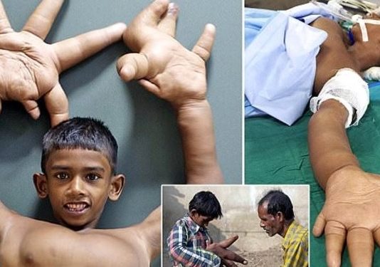 Puika Ar Pasaulē Lielākajām Plaukstām! Vietējie Viņu Dēvē Par Velna Bērnu!