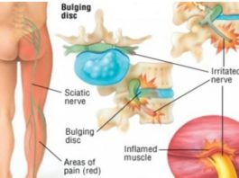 Izmanto Šo Vienkāršo Triku Un Aizmirsti Par Muguras Un Sēžas Sāpēm Uz Visiem Laikiem!