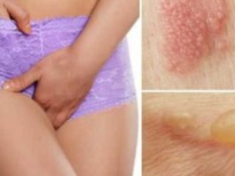 Ko Darīt, Ja Tu Redzi Tulznas Vai Čūlas Uz Savām Ģenitālijām? Nekrīti Panikā, Šeit Ir Pamācība, Kas Tev Nekavējoties Jādara