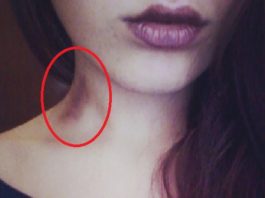 Zilumu Uzsūkšana Var Maksāt Dzīvību – Nekavējoties Pārtrauciet To Darīt – Tas Ir Bīstami Dzīvībai