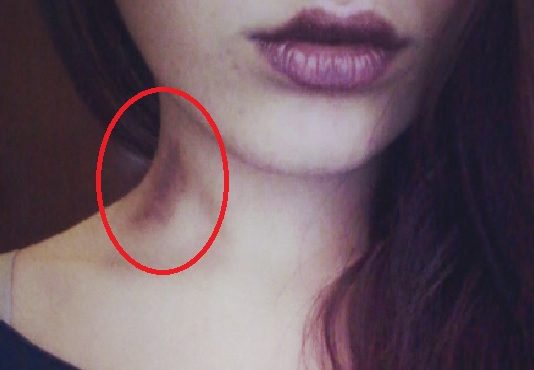 Zilumu Uzsūkšana Var Maksāt Dzīvību – Nekavējoties Pārtrauciet To Darīt – Tas Ir Bīstami Dzīvībai