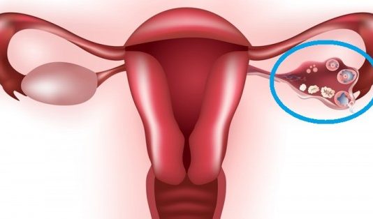 12 Dabas Aizsardzības Līdzekļi, Ar Kuriem Var Iznīcināt Olnīcu Cistas – Noderēs Ikvienai Sievietei!