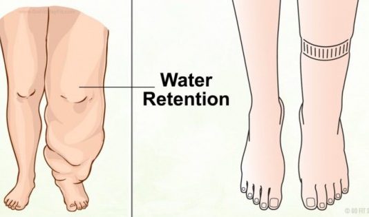 Ūdens Sakrāšanās Konkrētās Ķermeņa Vietās Var Izraisīt Nāvi! Kas Izraisa Ūdens Aizturēšānu Mūsu Organismā Un Kā No Tā Izvairīties?