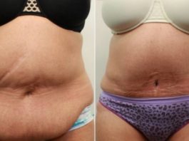 Nepārspējami Spēcīgs Dzēriens, Kas Sadedzinās Vēdera Taukus Vien Pāris Dienu Laikā!