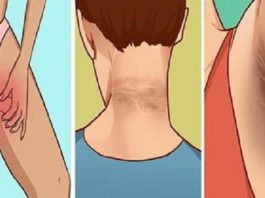 Kā Noņemt, Šos Neglītos Un Melnos Pleķus No Kakla, Padusēm Un Augšstilbiem, Tikai 15 Minūtēs!