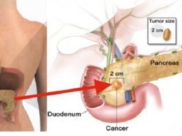 80% Cilvēku Ikdienā Lieto Šos Divus Produktus, Kas Ļoti Palielina Iespējas Saslimt Ar Aizkuņģa Dziedzera Vēzi. Nekavējoties Pārtrauc Tos Lietot!