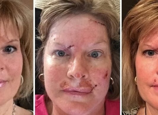 Pēc Visiem Šiem Solārijas Apmeklēšanas Gadiem, Viņas Pirmsnāves Vēlēšanās Bija Glābt Citus!