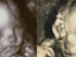 Kad Šī Sieviete Bija Sestajā Grūtniecības Mēnesī, Atklājās, Kas Tāds, Ko Noklusēja Pat Ārsti!