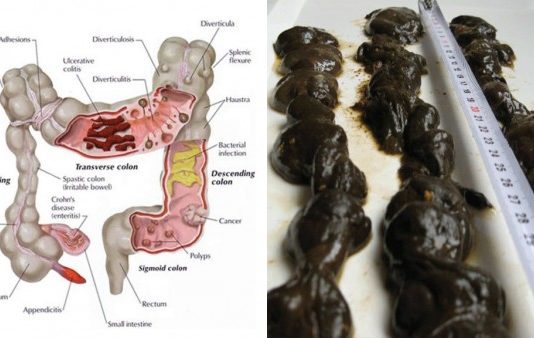 Ingvera, Ābola Un Citrona Unikālais Maisījums, Kas Izvadīs Kilogramiem Toksīnu No Jūsu Ķermeņa!