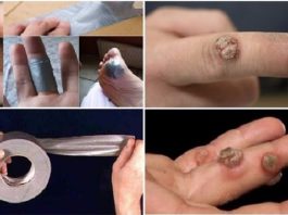 Tev Ir Kārpas Bet Nezini Kā No Tām Atbrīvoties? Izmēģini Līmlenti – Šo Triku Atbalasta Pat Vadošie Ārsti!