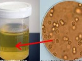 Ko Tava Urīna Krāsa Pastāsta Par Tavu Veselību?