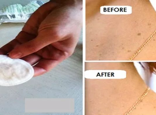 Likvidē Jebkuru Kārpu Vai Pumpu Ar Šo Dabisko Līdzekli! Tev Tas Noderēs Visai Dzīvei!