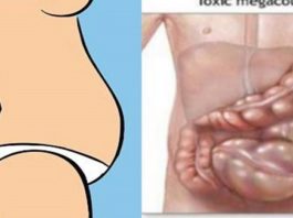 Tu Neesi Resna! Tev Ir Vienkārši Pārlieku Uzpūties Vēders! Uzzini Veidu, Kā No Tā Atbrīvoties!