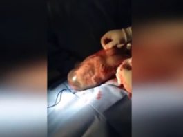 Nekas Tāds Iepriekš Nav Redzēts! Māte Domāja, Ka Viņai Piedzima Parasts Mazulis, Taču Tiklīdz Viņa To Ieraudzīja – Šokā Bija Pat Ārsti!