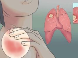 Vadošie Ārsti Brīdina – Sievietēm Jābūt Piesardzīgām! 20 Plaušu Vēža Pazīmes, Kuras Sievietēm Nekad Nevajadzētu Ignorēt!