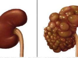 Ja Vēlies, Lai Tavas Nieres Ir Veselas Uz Visu Atlikušo Mūžu, Tad Nekavējoties Pārtrauciet Darīt Šīs Lietas!