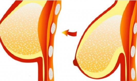 Jūsu Krūtis Nekad Vairs Nebūs Nokarenas, Ja Darīsiet Šo Vienkāršo Lietu!
