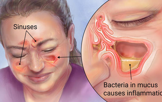 Iznīcini Deguna Blakus Dobuma Infekciju Vienas Dienas Laikā! Viss Nepieciešamas Atrodas Jums Virtuvē!