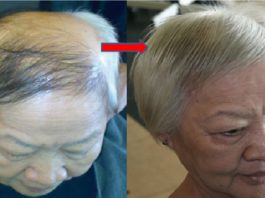 Daži Pilieni Šī Sīrupa Uz Skalpa, Palīdzēs Ataugt Matiem Pilnībā!