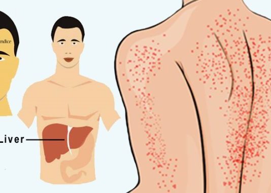12 Bīstami Veidi, Kā Jūsu Organsisms Mēģina Pateikt, Ka Jūsu Aknas Ir Smagi Bojātas