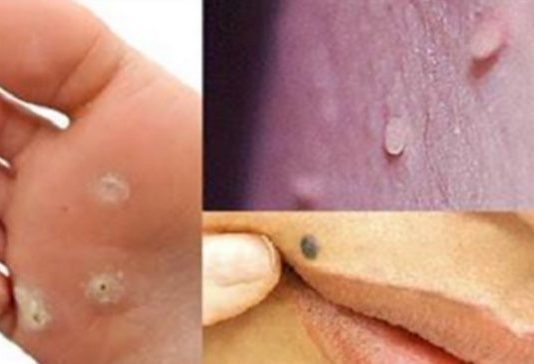 Pavisam Dabīgs Un Pavisam Vienkāršs Veids Kā Iznīcināt Kārpas, Pinnes, Dzimumzīmes, Vecuma Plankumus Un Ādas Ļipiņas!