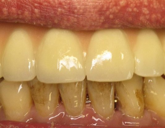 Viņš Savos 72 Dzīves Gados Ne Reizi Savā Mūžā Nav Bijis Pie Zobārsts. Un Viss Tikai Pateicoties Šim Līdzeklim