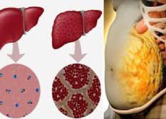 Kā 3 Dienu Laikā Pilnībā Attīrīt Un Detoksicēt Aknas