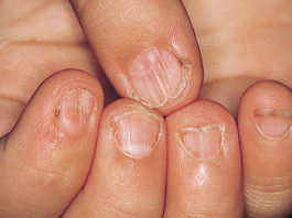 Ja Jūsu Nagi Plīst Un Šķeļās, Jums Iespējams Draud Šis!