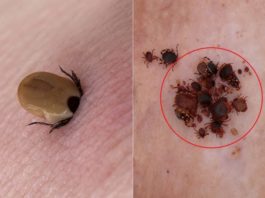 Šis Gados Vecais Lauksaimnieks Nomira No Pēkšņa Ērces Koduma, Taču Kad Ārsti Viņu Pārmeklēja… Ak Dievs!