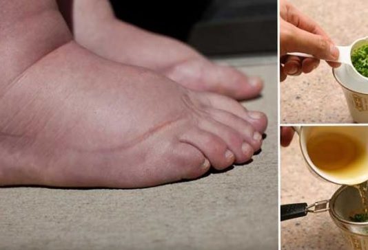 Ūdens Aizture Tavā Organismā Var Būt Dzīvībai Bīstama – Uzzini Kā No Tās Nekavējoties Atbrīvoties!