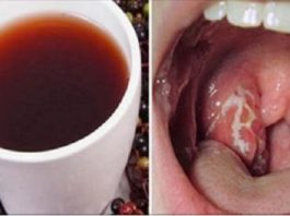 Beidziet Vienreiz Izmest Milzu Naudu Par Zālēm! Atbrīvojies No Kakla Infekcijas Ar Dabiskiem Līdzekļiem Vien 4 Stundu Laikā