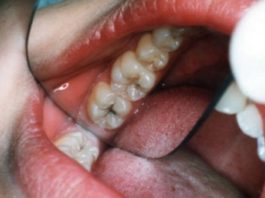 Dabīga Zobu Pasta, Kas Cīnās Pret Zobu Caurumiem. Pagatavo To Jau Šodien