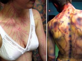 Apskati, Kā Izskatās Cilvēka Ķermenis Pēc Tam, Kad Viņiem Ir Iespēris Zibens