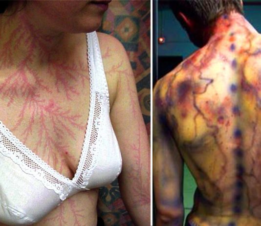 Apskati, Kā Izskatās Cilvēka Ķermenis Pēc Tam, Kad Viņiem Ir Iespēris Zibens