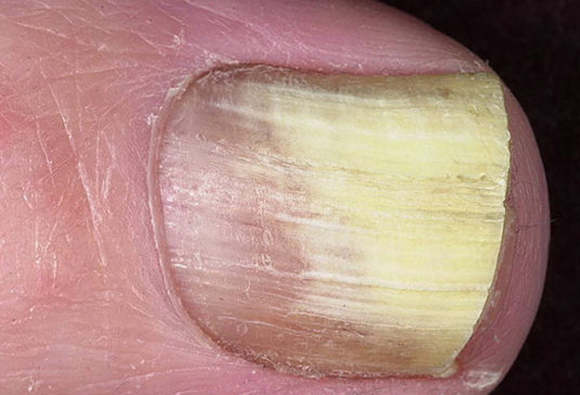 Kā Pilnībā Atbrīvoties No Nagu Sēnītes 2 Nedēļu Laikā