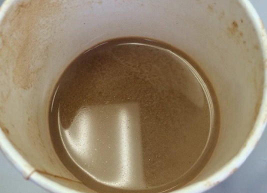 Zobārsti Ir Pārsteigti Par Rezultātiem, Ko Dod Šī Mājas Recepte Pret Zobakmeni