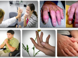 Bīstamie Multiplās Sklerozes Simptomi : Tirpšana, Nogurums Un 12 Priekšlaicīgi Bīstamās Pazīmes