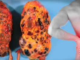 8 Bīstami ieradumi, kuri var pilnībā apstādināt Jūsu nieres darbību, pie tam Jūs to darāt katru dienu!