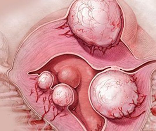 Cistas vai miomas gadījumā izmēģiniet šo dzērienu! Tas palīdzēs jau četru dienu laikā!